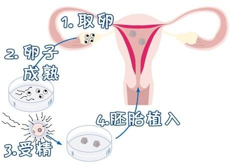 关于三代试管供卵机构男孩